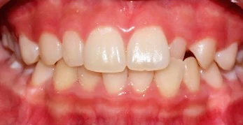 Patient with crowded teeth, before treatment